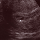 Illustration for article titled Perpetually Annoying Slate Writer Sez Calling It A Fetus Might Lead To Infanticide